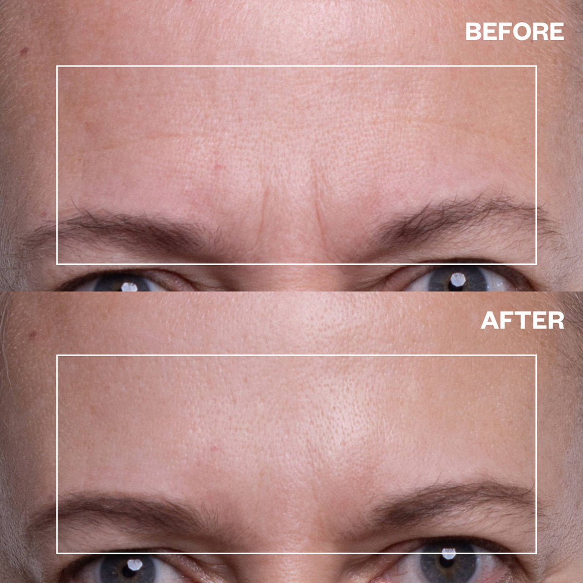 Forehead Wrinkle Patches