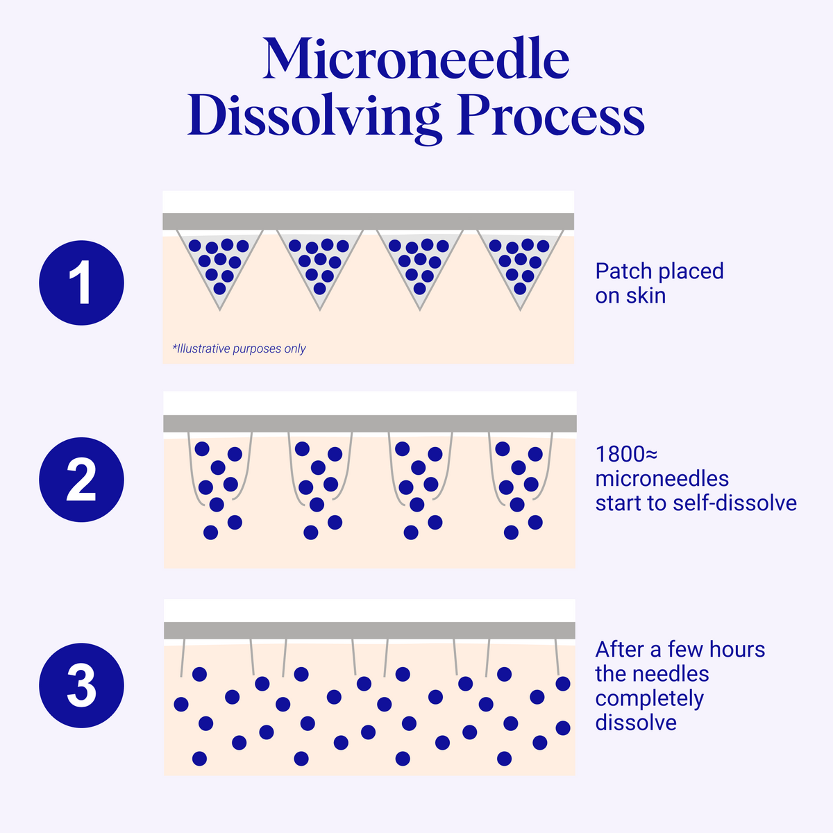 Self-Dissolving Microneedle Patches: Single